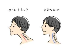 ストレートネックと正常な首の比較