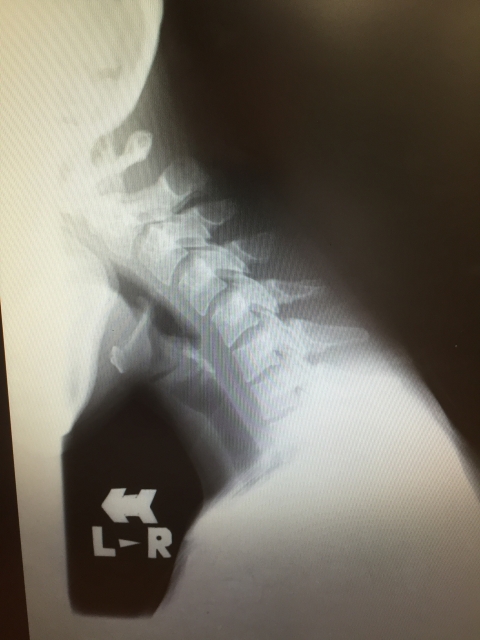 ストレートネックのレントゲン